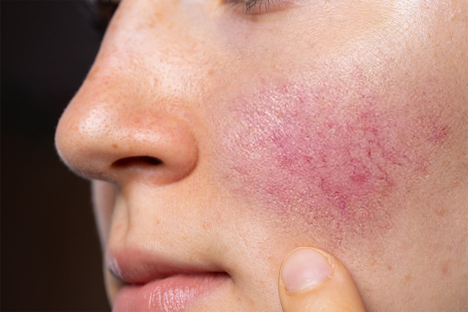 Rosacea vs Acne: How To Spot the Difference