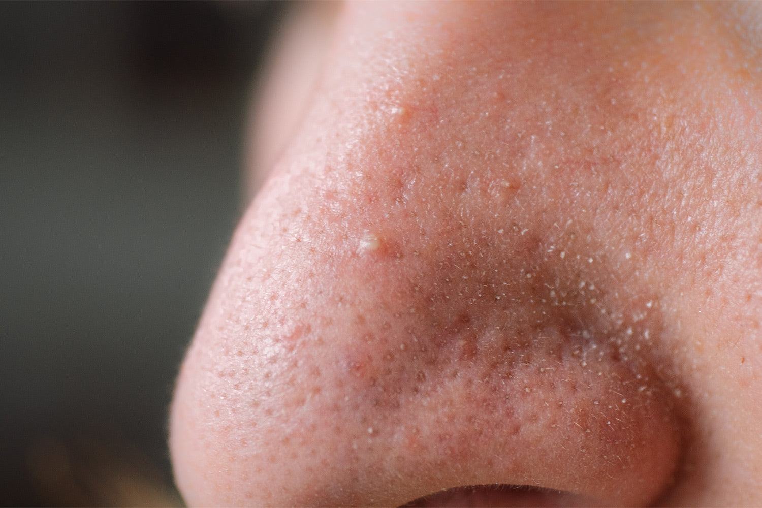 Clogged Pores On Face: Causes, Treatment and Prevention